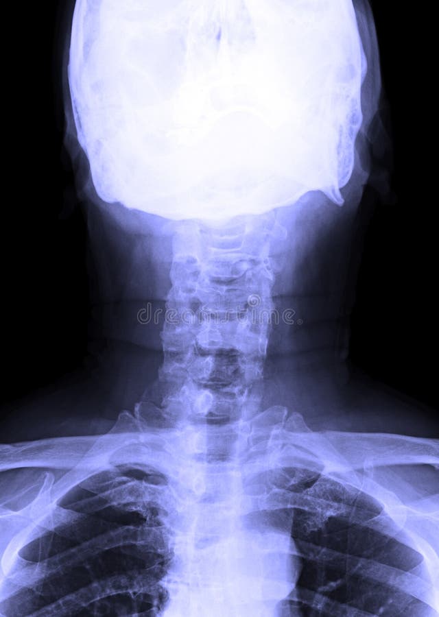 radiologiczny wizerunek męska ludzka szyja obrazy royalty free radiologiczny wizerunek męska ludzka szyja obrazy royalty free
