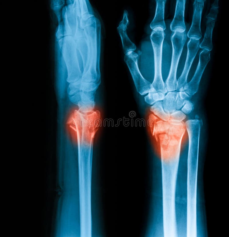 Radiologiczny wizerunek nadgarstku jiont, AP i lateral widok zdjęcie royalty free