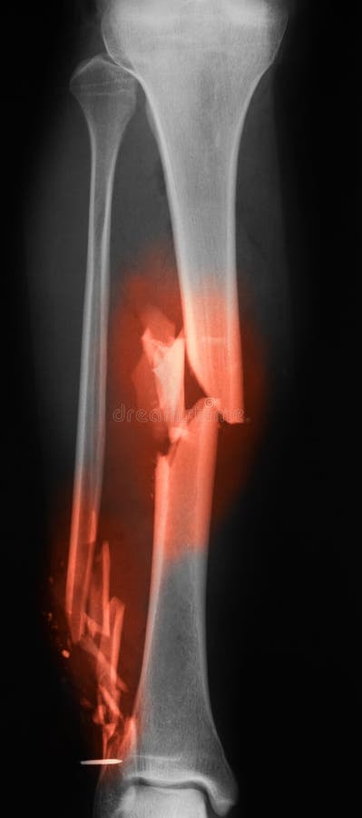 Radiologiczny wizerunek złamana noga AP widok zdjęcie stock