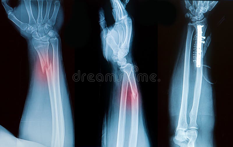 Radiologiczny wizerunek łamana przedramię kość zdjęcie stock Radiologiczny wizerunek łamana przedramię kość zdjęcie stock
