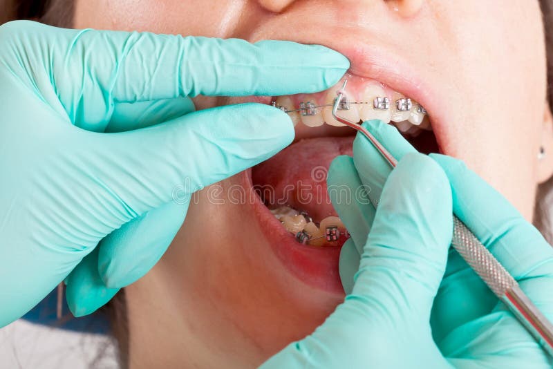 10 Pezzi Cera Ortodontica Cera Dentale Per Parentesi Graffe 50 Strisce - Foto 6