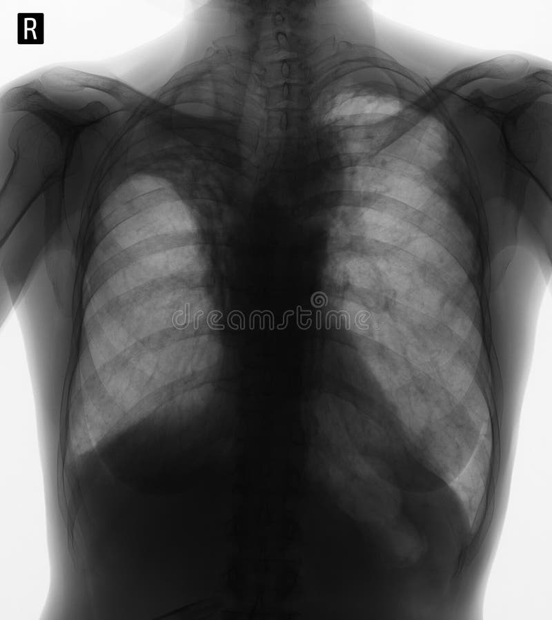 Raggi x dei polmoni: Pneumofibrosis di Postradiation Negativo fotografie stock libere da diritti Raggi x dei polmoni: Pneumofibrosis di Postradiation Negativo fotografie stock libere da diritti