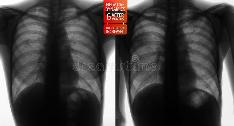 Raggi x dei polmoni: Tubercolosi di incremento dei polmoni dopo 6 mesi Negativo fotografia stock libera da diritti Raggi x dei polmoni: Tubercolosi di incremento dei polmoni dopo 6 mesi Negativo fotografia stock libera da diritti
