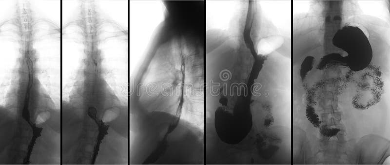 Raggi x del tratto gastrointestinale superiore UGI con bario Ernia iatale Negativo