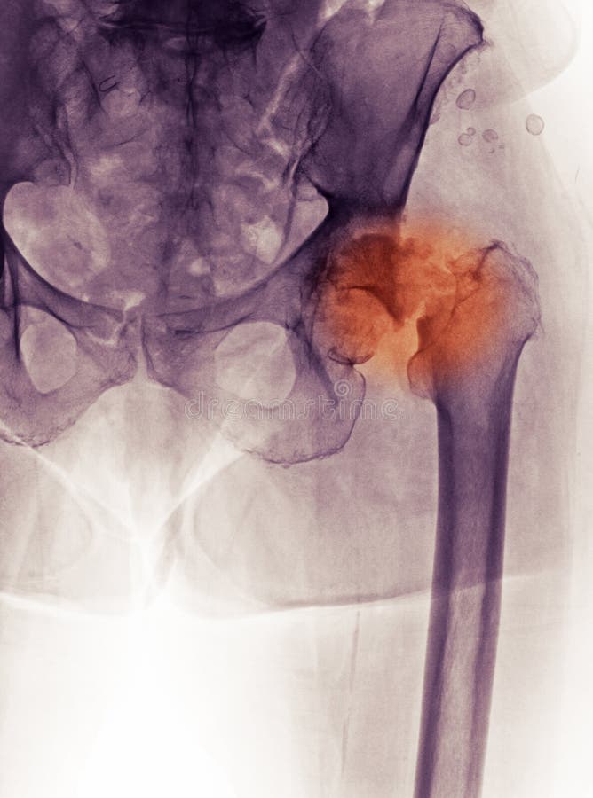 Raggi X dell'anca, fessura e DJD (giunto degenerante d)