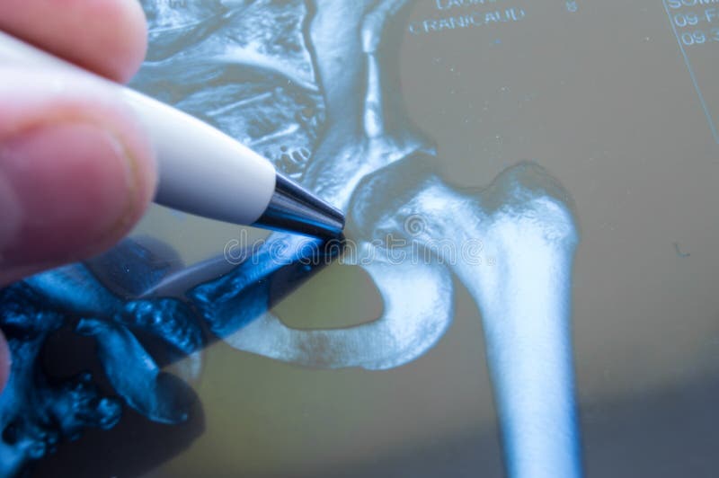 Raggi x dell'articolazione dell'anca Aggiusti aguzzo su area dell'articolazione dell'anca, in cui la patologia è individuata, qua