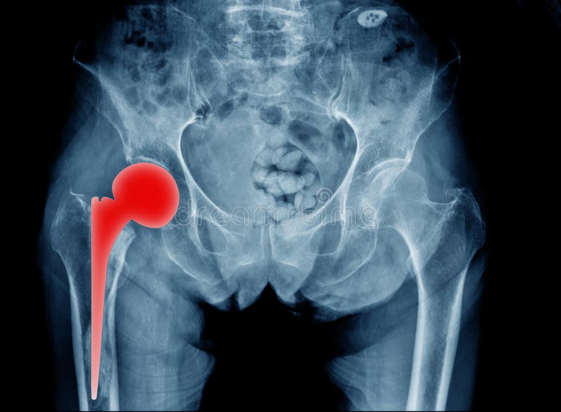 Raggi x della sostituzione dell'anca