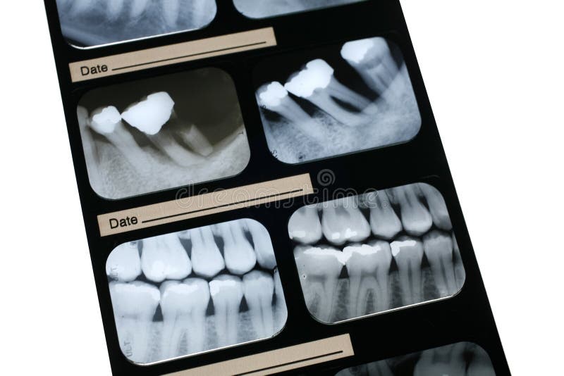 Buste Protettive Per Sensori Dentali Buste Barriera Monouso Per Raggi X Digitali Dentali - Formati #0, #1, #2 Per Fosfori Pannello Forex 3 Mm - Foto 8