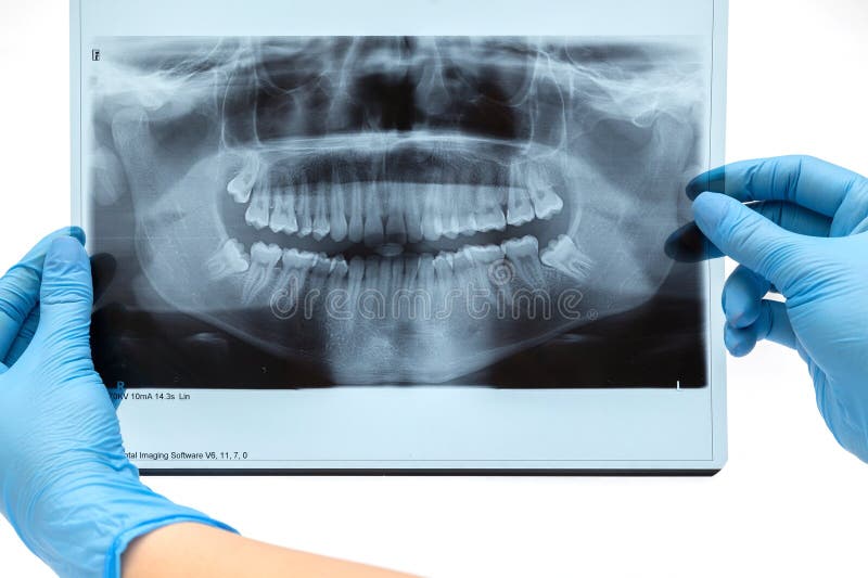 Con Morsetto Rapido Porta Raggi X Dentali 15 Kwik-Bite Con Indice Kerr 270 - Per Odontoiatria E Laboratori Dentali Shark Visiera - Foto 8
