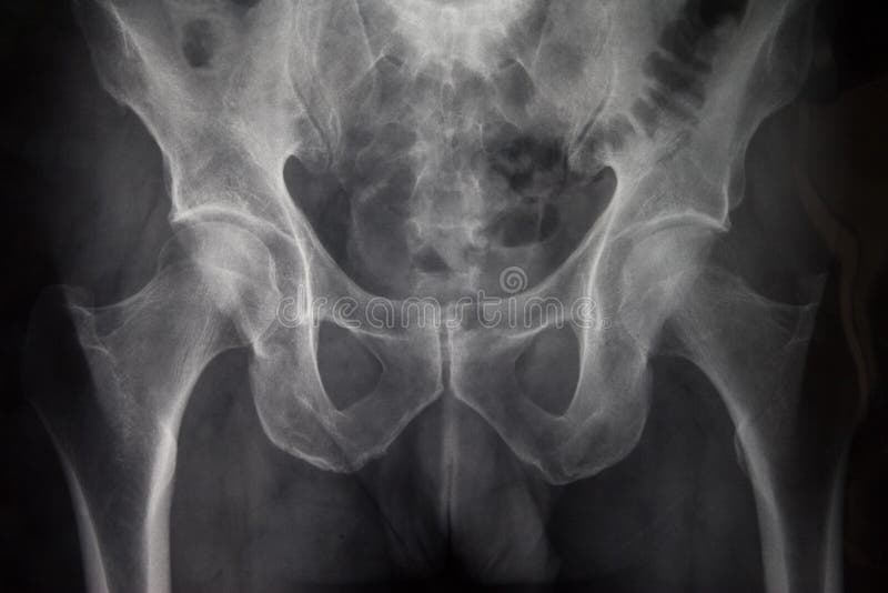 Spina Dorsale E Raggi X Pelvici Immagine Stock - Immagine ...