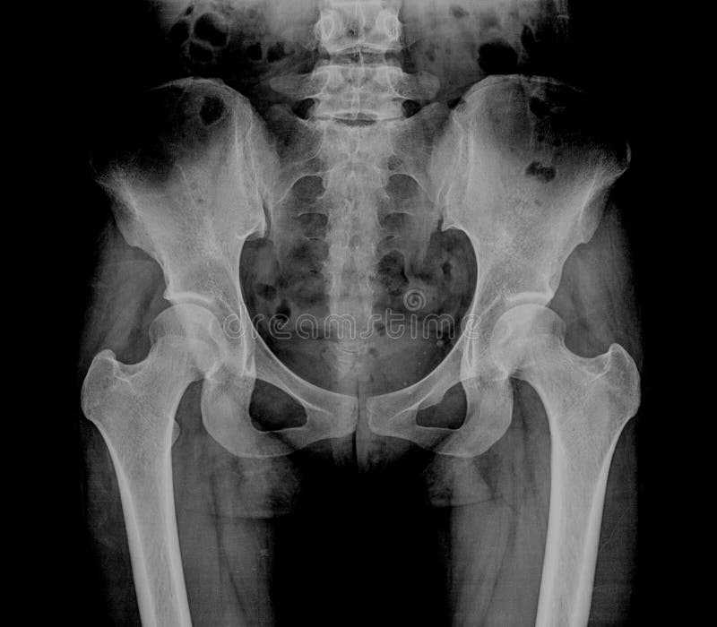 Raio X anca do osso, corpo humano