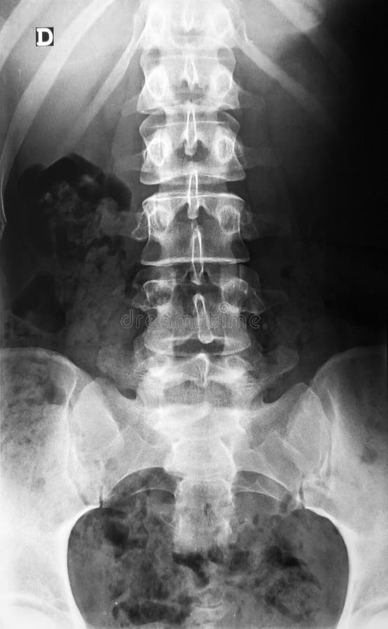 Raio X da coluna espinal