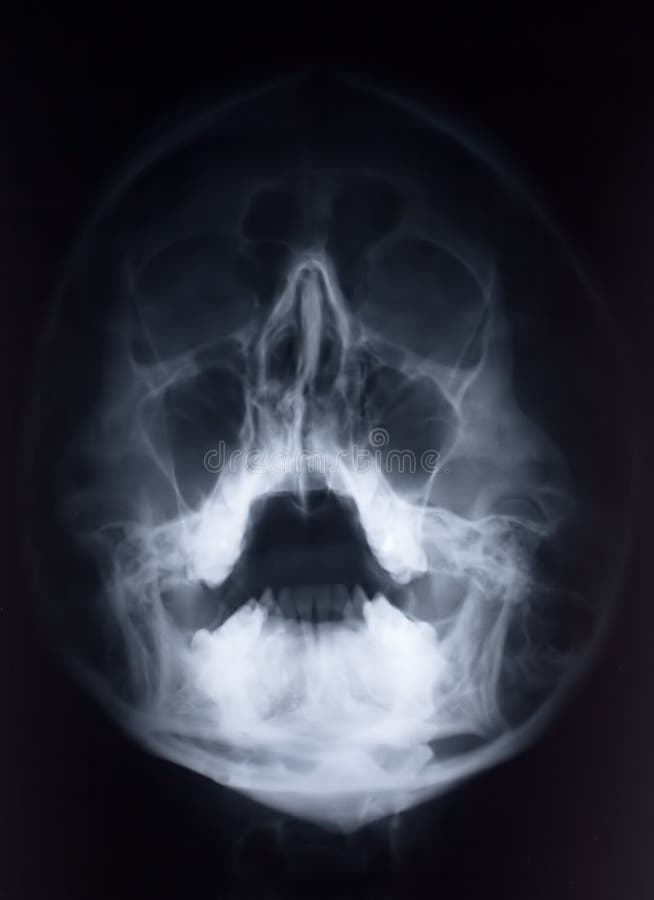 Raio X da face foto de stock. Imagem de ciência, ossos - 1792828