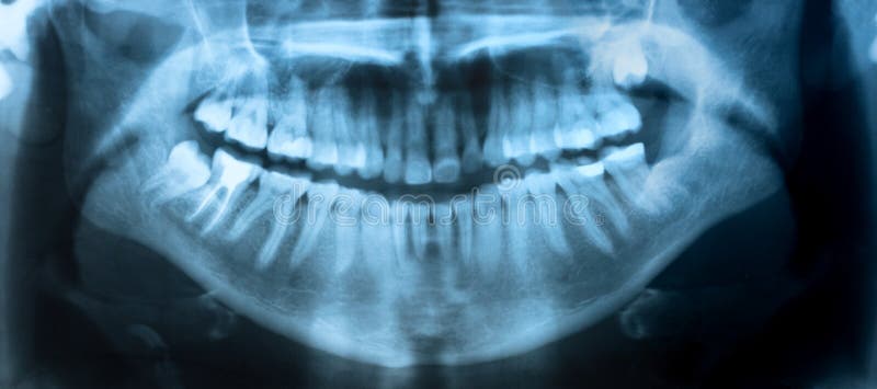 Dental X-Ray. A panoramic x-ray of a mouth, with intact wisdom teeth, one of which is severely impacted. Dental X-Ray. A panoramic x-ray of a mouth, with intact wisdom teeth, one of which is severely impacted.