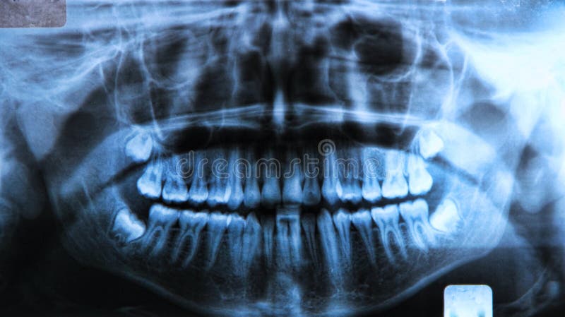 Panoramic x-ray of a mouth, with intact wisdom teeth: Panoramic radiography, also called panoramic x-ray, is a two-dimensional (2-D) dental x-ray examination that captures the entire mouth in a single image, including the teeth, upper and lower jaws, surrounding structures and tissues. This examination is also used to plan treatment for full and partial dentures, braces, extractions and implants. Panoramic x-ray of a mouth, with intact wisdom teeth: Panoramic radiography, also called panoramic x-ray, is a two-dimensional (2-D) dental x-ray examination that captures the entire mouth in a single image, including the teeth, upper and lower jaws, surrounding structures and tissues. This examination is also used to plan treatment for full and partial dentures, braces, extractions and implants