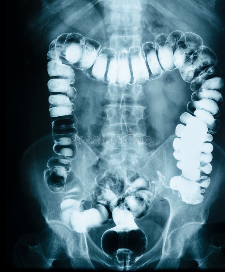 Small intestine obstruction Film X-ray abdomen supine. Small intestine obstruction Film X-ray abdomen supine