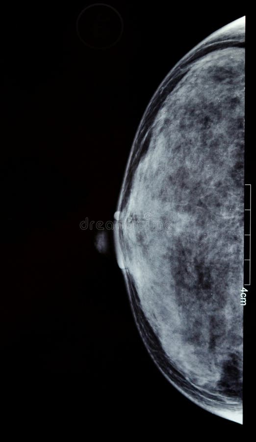 Molybdenum target X-ray, breast X-ray pictures. Molybdenum target X-ray, breast X-ray pictures