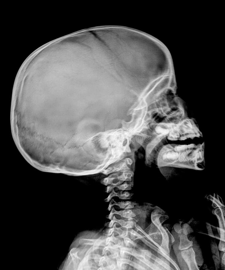 Детский череп рентген. Рентген черепа новорожденного. Снимок рентгена черепа младенца. Череп ребенка рентген норма.