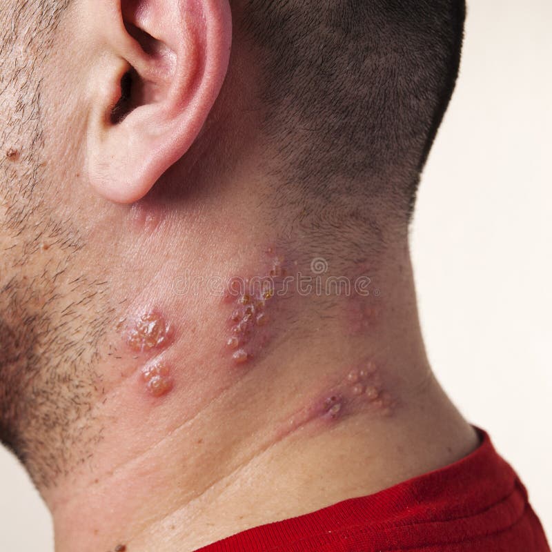 Raised Red Bumps And Blisters Caused By The Shingles Virus Stock Photo