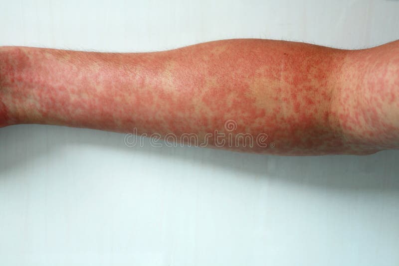 Rash stock photo Rash stock photo