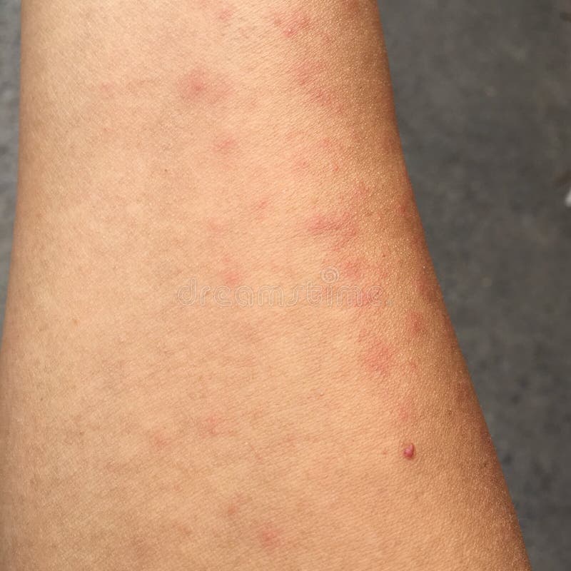 Rash Caused By Skin Allergic To Sweat Dust And Viruses Stock Image