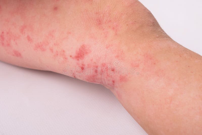 Rash On A Child Leg On White Background Redness Allergic Reaction