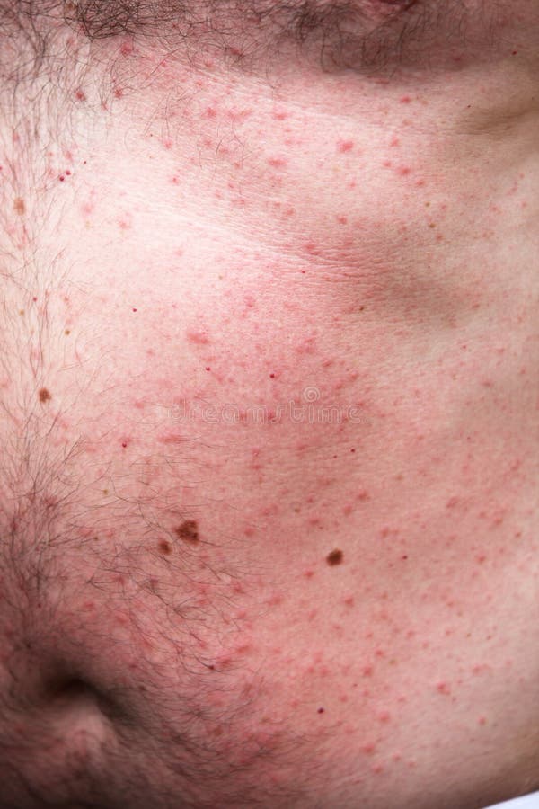 Rash Or Sun Allergy Royalty Free Stock Photography Image 14962727