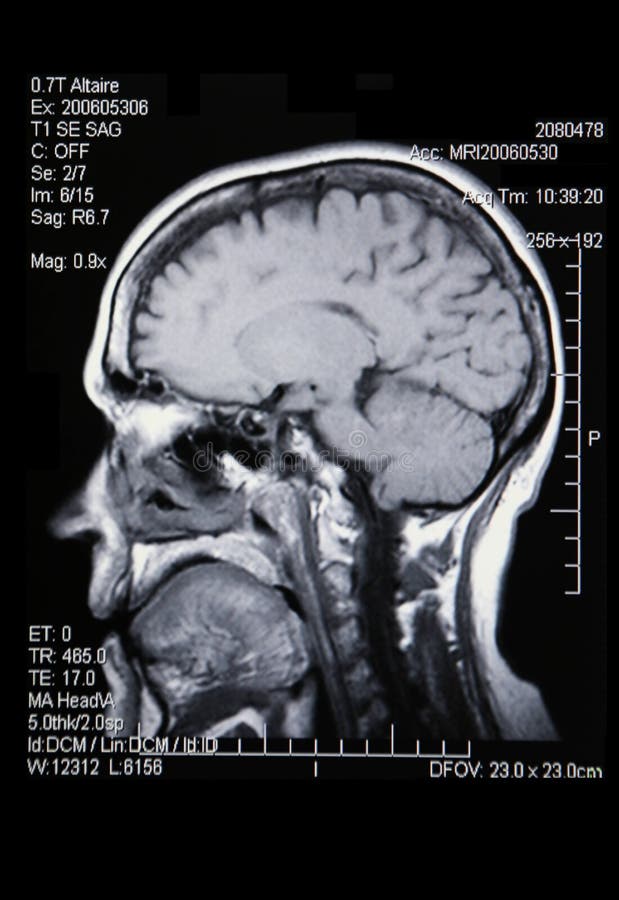 Skutečný MRI / MRA (Magnetická Rezonance Angiogram) mozkových cév (tepny) v černobílé.