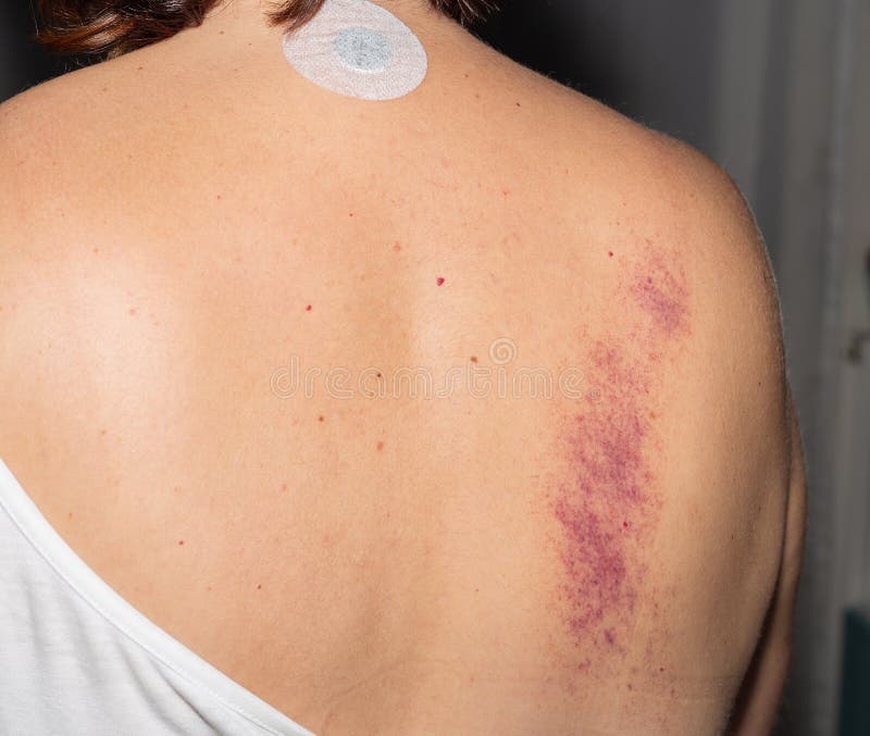 Hairdresser's photo shows bruised back and the physical toll of her job