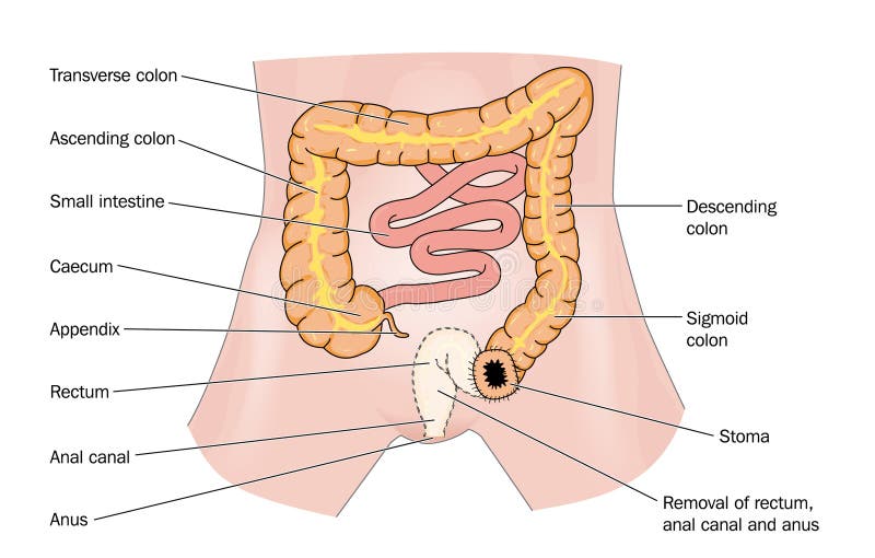 Rectal cancer and stoma