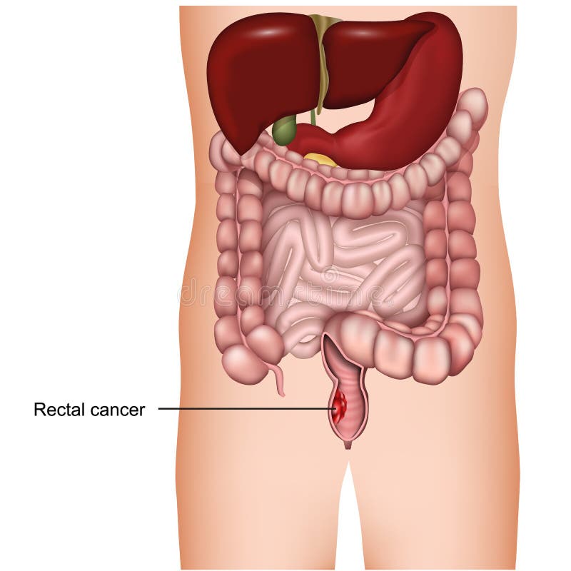 Rectale kanker medische 3d illustratie op witte achtergrond, colorectal kanker vector illustratie Rectale kanker medische 3d illustratie op witte achtergrond, colorectal kanker vector illustratie