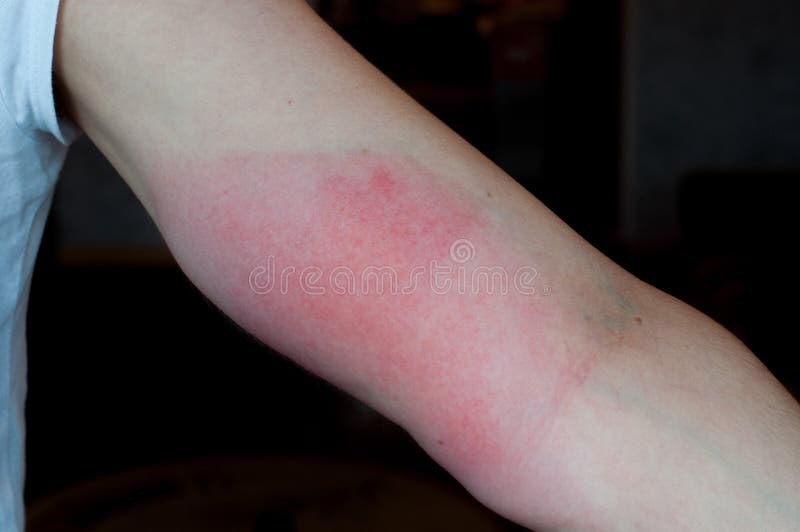 Yellow Jacket Sting Allergy