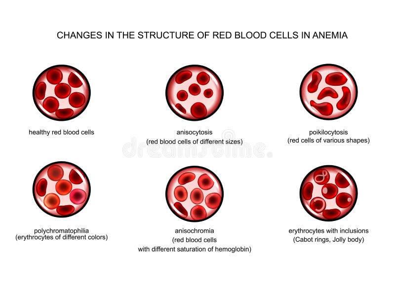 Red Blood Cells In Various Anemias Stock Vector Illustration Of