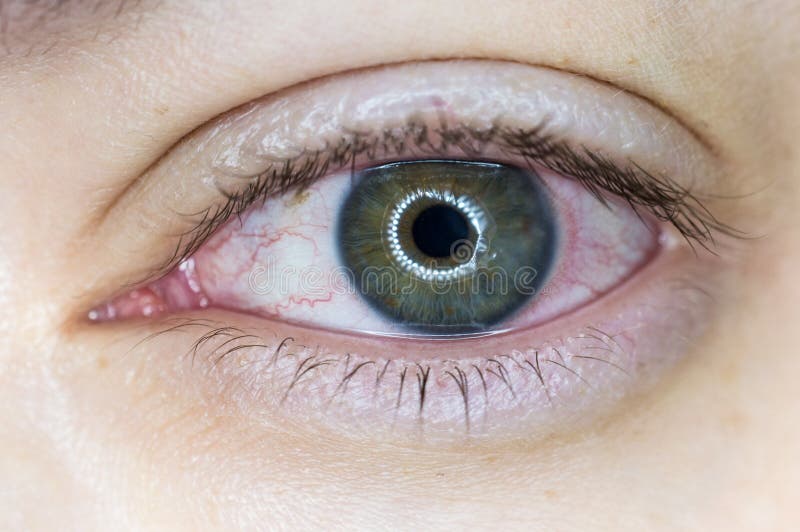 7,093 Eye Infection Photos - Free & Royalty-Free Stock Photos from