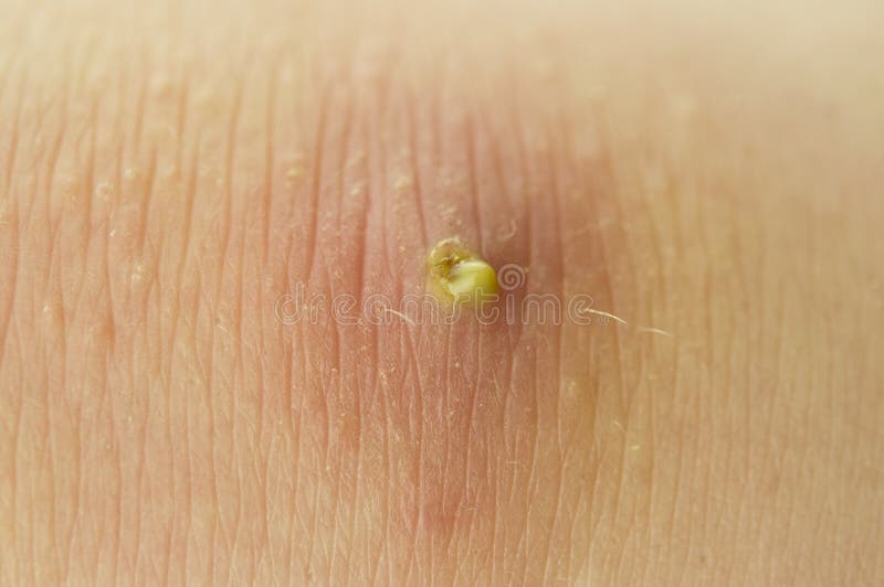 Red Purulent Pimple on the Skin Stock Image Image of patient