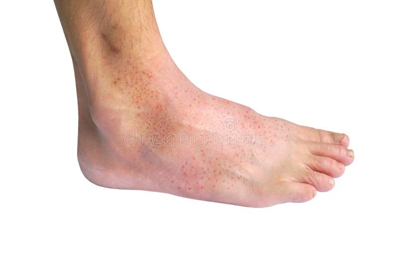round red prot on foot round red prot on foot