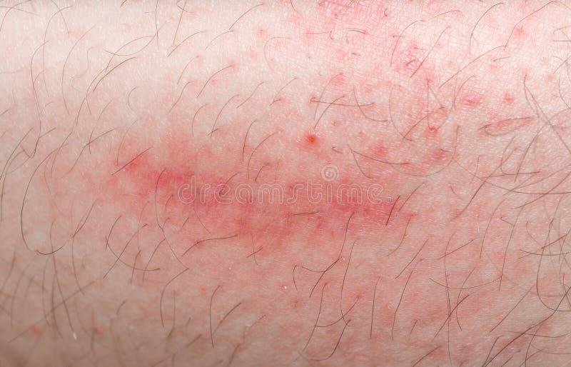 Red rush on leg skin stock image. Image of medicare, skin 66742153