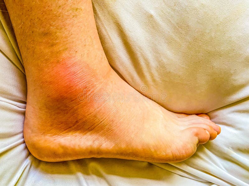 Red Swollen Ankle On Foot Due To Acute Gout Stock Photo Image Of