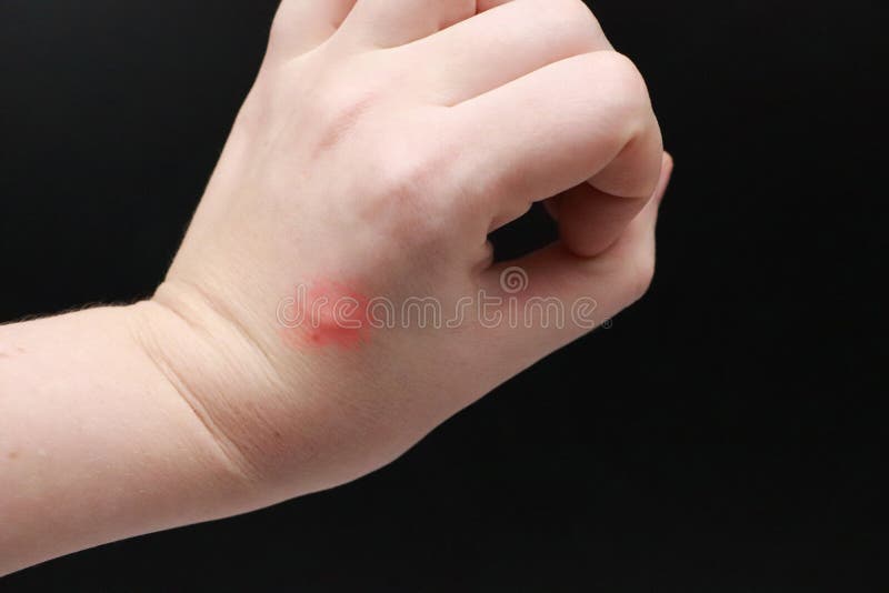 Insect Bites On Female Hand Stock Photo Image of health, infection