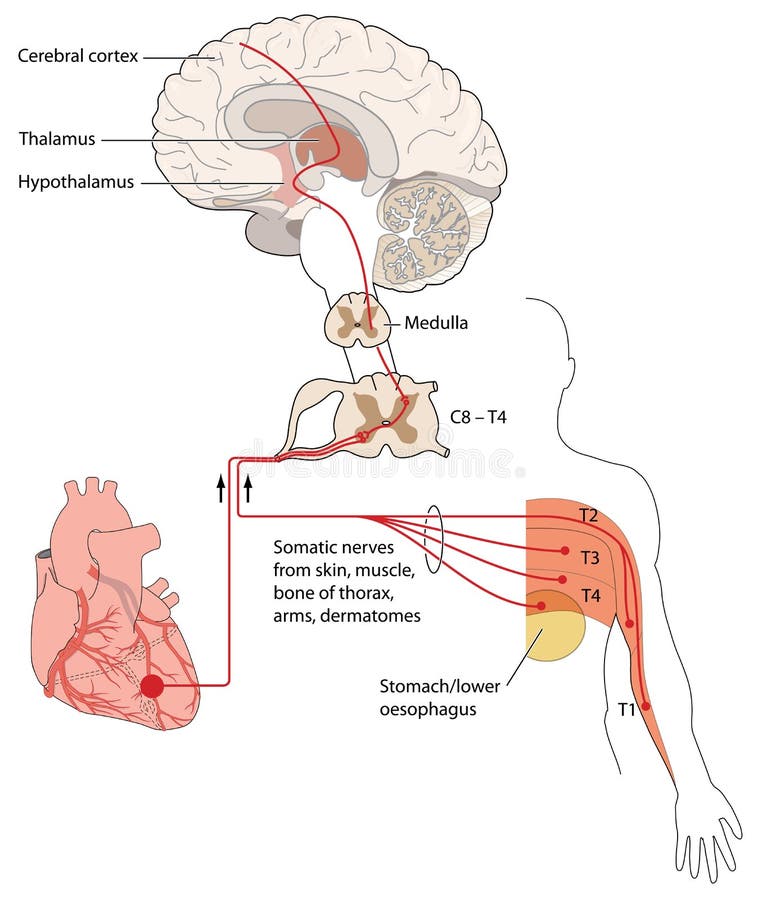 Referred Pain Signals Heart and Chest Stock Vector Biology Diagrams