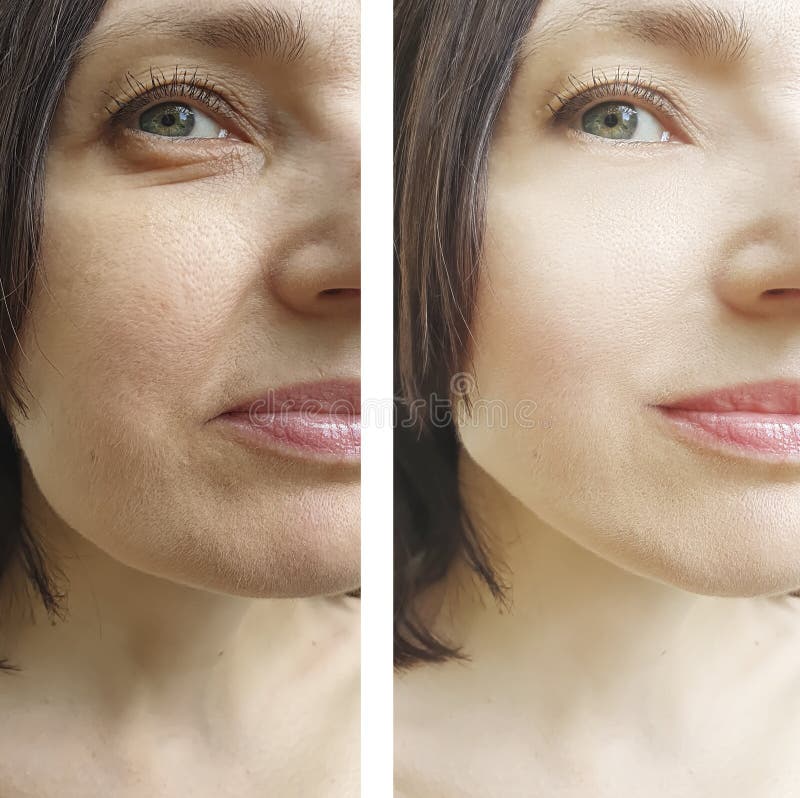 Rejuvenescimento da correção do elevador da remoção dos enrugamentos da cara da mulher antes e depois da correção