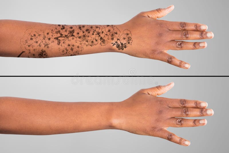 Remoção De Tatuagem Laser Na Mão Das Mulheres Foto de Stock - Imagem de  laser, interior: 214013894