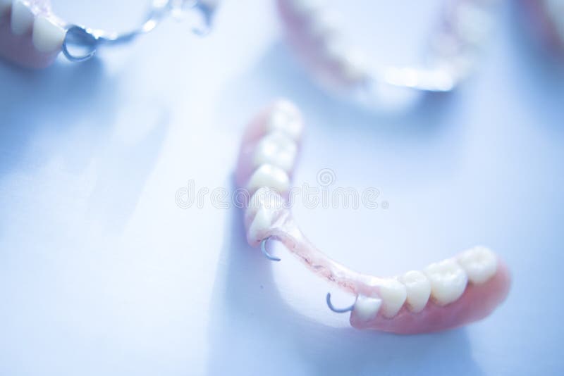 Snímatelný částečný zubní protéza kov a plastický zubní falešný zuby.