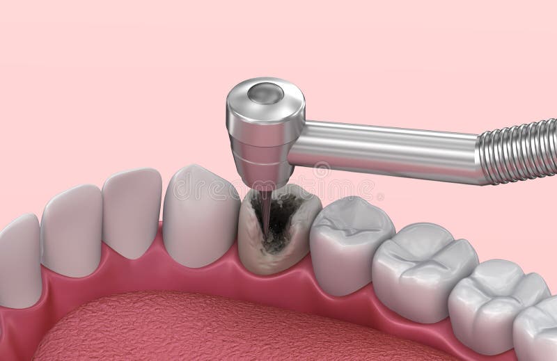 Removing the Caries . Medically Accurate Tooth Illustration Stock