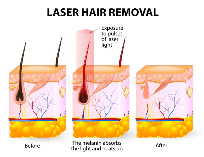 Remoção do cabelo do laser. Diagrama do vetor