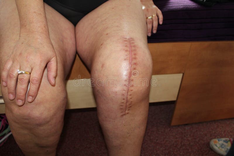 Remplacement total de genou, chirurgie de genou photo stock Remplacement total de genou, chirurgie de genou photo stock