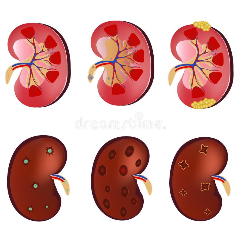 rene rassodato di vettore realistico di anatomia 3D, rene normale, infezione del rene, rene malato Essere umano di anatomia Conce illustrazione di stock rene rassodato di vettore realistico di anatomia 3D, rene normale, infezione del rene, rene malato Essere umano di anatomia Conce illustrazione di stock