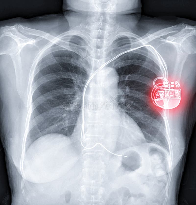 Rentgen klatki piersiowej lub obraz rentgenowski klatki piersiowej z ukÅ‚adaniem rozrusznika
