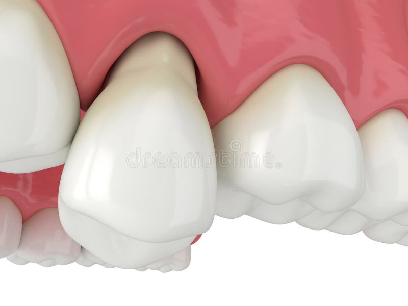3d render of jaw with tooth protruding from the gums over white. 3d render of jaw with tooth protruding from the gums over white