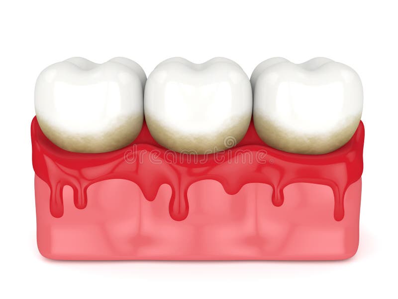 3d render of teeth in bleeding gums over white background. Periodontal disease concept. 3d render of teeth in bleeding gums over white background. Periodontal disease concept